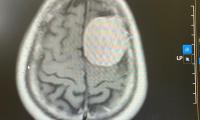 Bất ngờ đau đầu dữ dội, bất tỉnh do khối u khổng lồ trong não